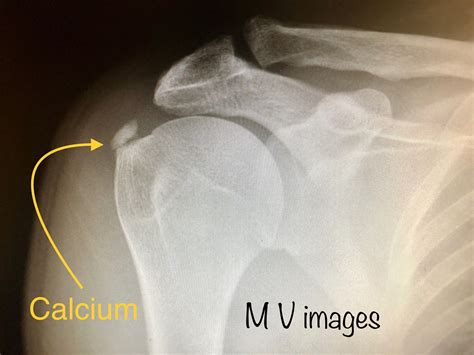 Shoulder X Ray Calcium Deposit at Timothy Stump blog