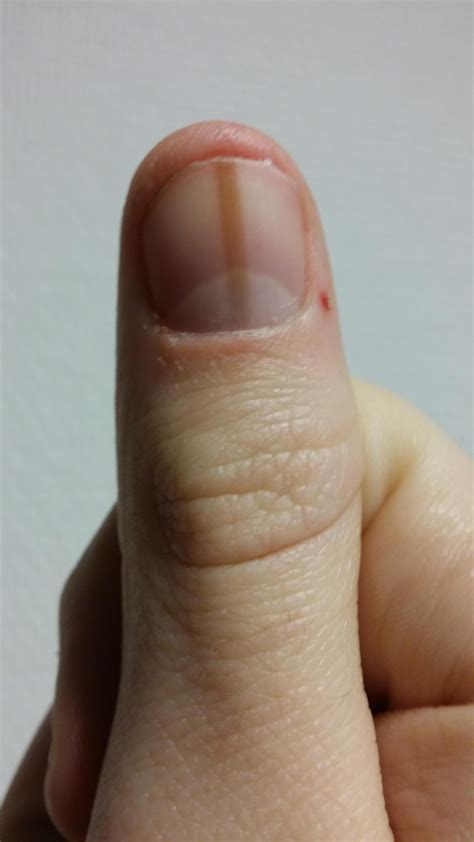 Brown Spot Under Fingernail No Pain at Margaret Beres blog