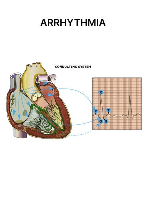 Arrhythmia Definition 的图像结果