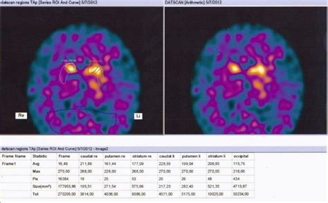 Rezultat imagine pentru Dat Brain Scan