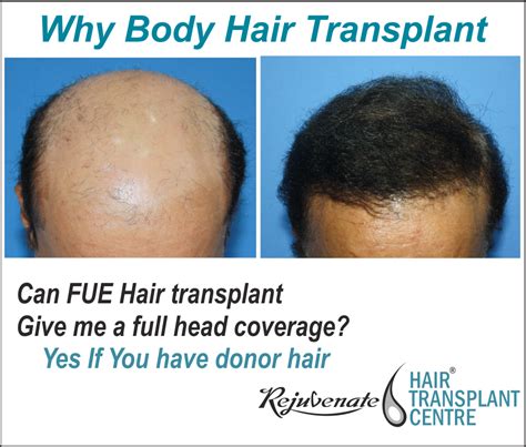Why Body Hair Transplant (BHT)