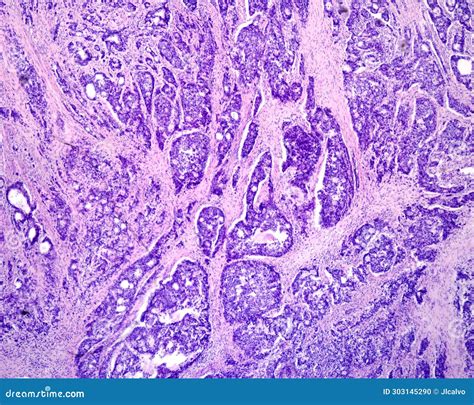 Human Prostate Cancer. Adenocarcinoma Stock Photo - Image of microscope, micrograph: 303145290