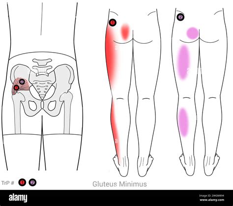 Gluteus minimus: Myofascial trigger point referred pain in the hips ...