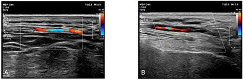 Temporal Artery Biopsy