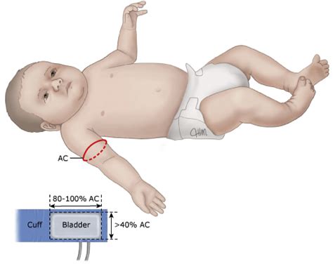 Neonatal Blood Pressure Standards - Clinics in Perinatology