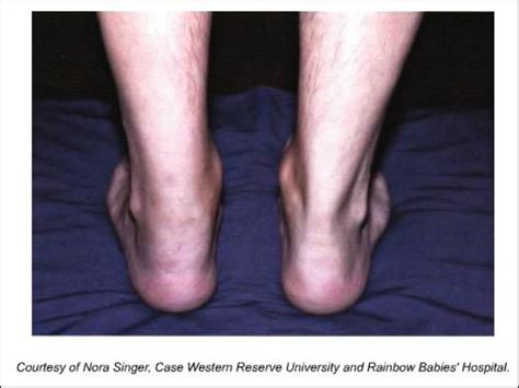 Infection-induced arthritis - Paediatrics and Child Health