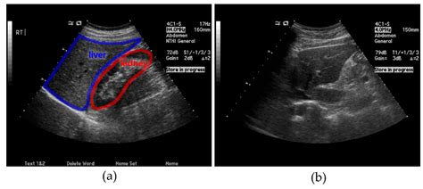 Normal Liver Radiography Examples – IVMR