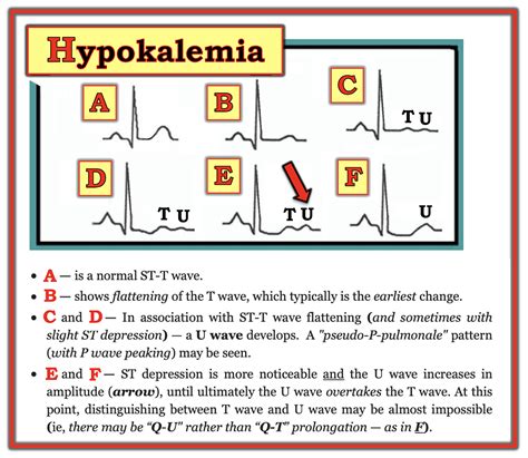 Dr. Smith's ECG Blog: Adding to the many faces of Hypokalemia....