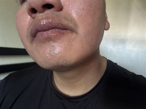 Small white itchy bumps on lips, nostrils : r/DermatologyQuestions
