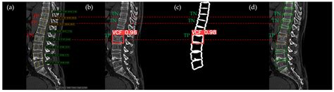 Enhanced Detection Performance of Acute Vertebral Compression Fractures ...