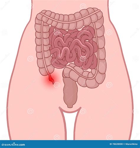 Inflammation of the Appendix Stock Vector - Illustration of cecum, medicine: 78628008
