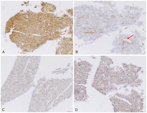 Protoporphyrin IX (PpIX) Fluorescence during Meningioma Surgery ...