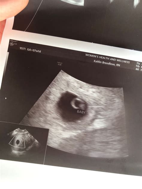 6 Week Ultrasound 2024