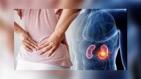 Kidney Stone causes and symptoms health tips kidney failure kidney ...
