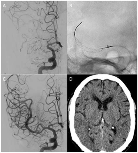 The Stream Device—A Retrospective Review of 51 Cases