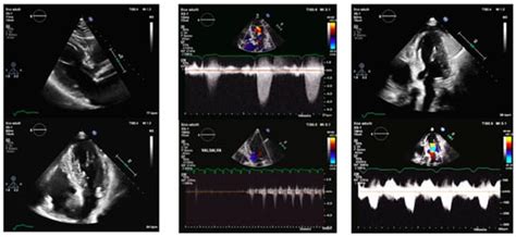 Silent Threats of the Heart: A Case Series and Narrative Review on ...