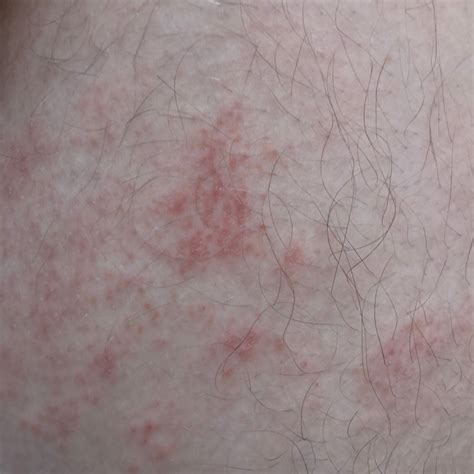 Fungal Diaper Rash Icd 10 at Enrique Branham blog