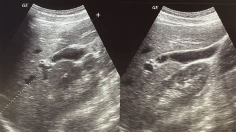 Gallbladder Ultrasound: Purpose, Preparation, Results and More