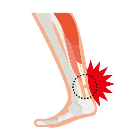 Achilles Tendon Rupture Achilles Tendon Tear Or Rupture | Ankle