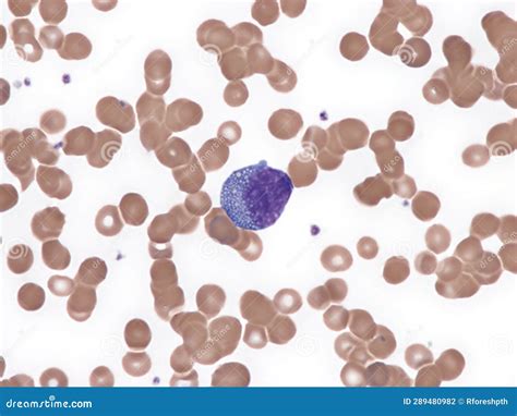 Blast Cell In Peripheral Blood (Natalizumab). Stock Photography ...