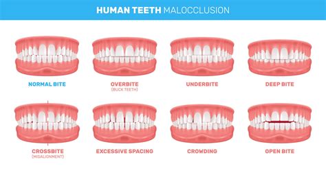 Maloclusiones dentales y ortodoncia - Carlos Saiz Smile