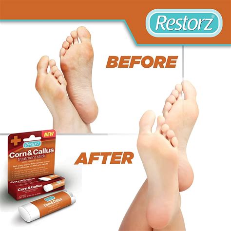 Restorz Corn and Callus Remover Stick with Salicylic Acid | Gentle ...