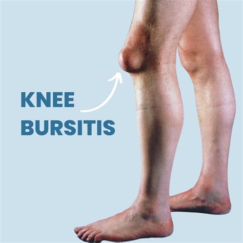 Bursitis knee – Artofit
