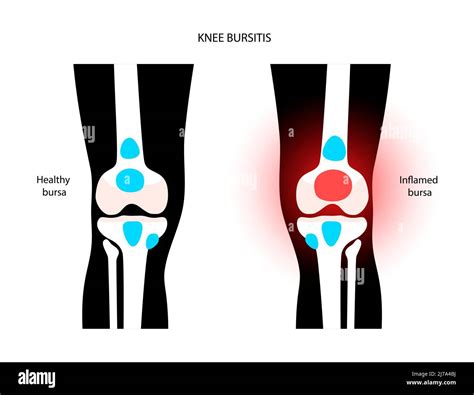 Knee bursitis, conceptual illustration Stock Photo - Alamy