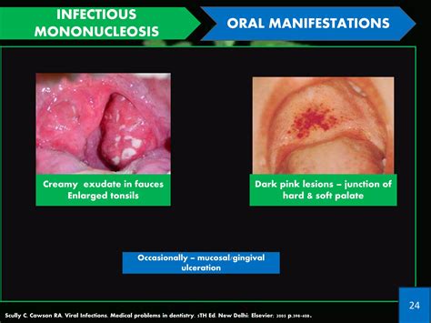 Mononucleosis Mouth Ulcers