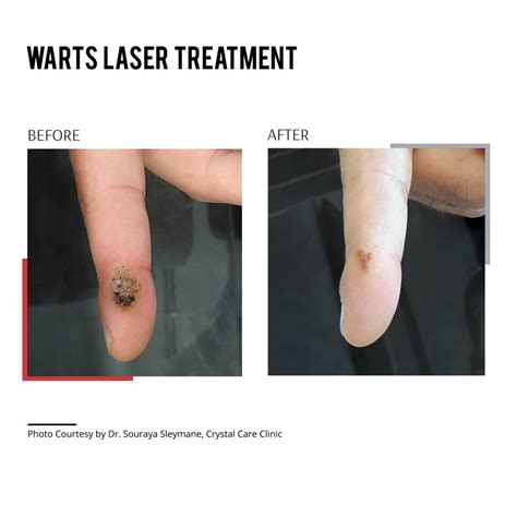 Laser Wart Removal