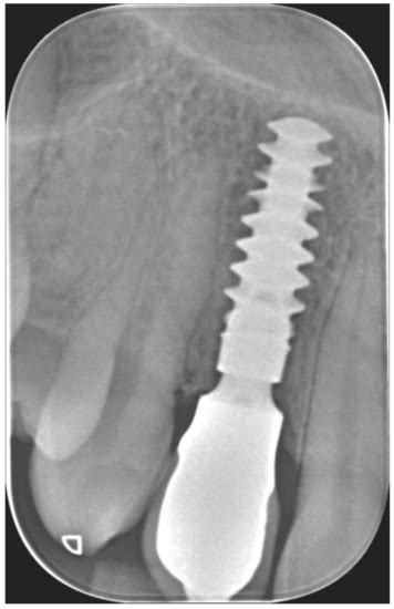 Immediate vs. Delayed Placement of Immediately Provisionalized Self ...