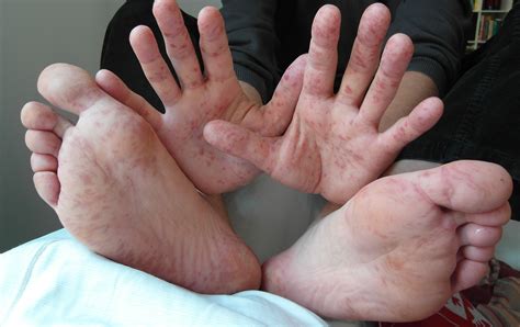 Hand Foot and Mouth Disease: Symptoms, Causes and Treatments | New ...