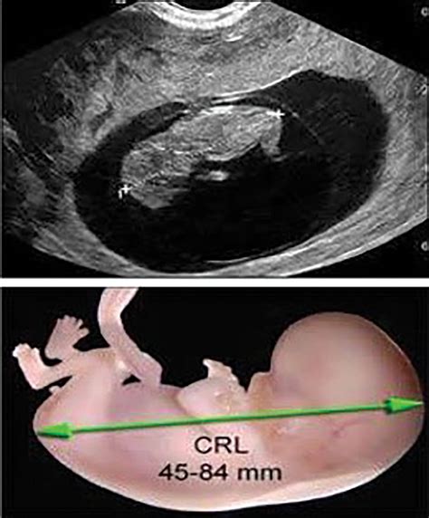 Obstetric Measurements and Gestational Age - Clinical Tree