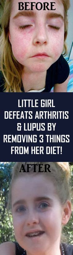 arthritis lupus