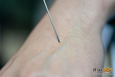 一枚细长的小针，在身上扎几下，就把多年顽疾治好了？！