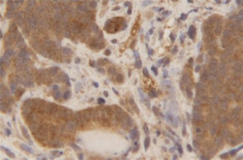 Metastatic prostate cancer may have its own biomarker, UB research ...