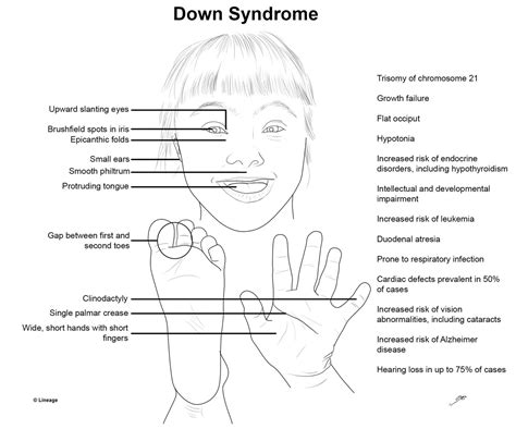 Down Syndrome - Pediatrics - Medbullets Step 2/3