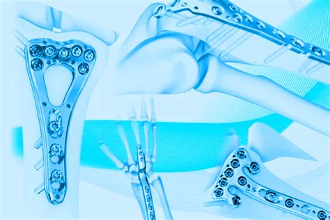 Advertorial: NuIndia Ortho suppliers of essential Ortho implants for ...