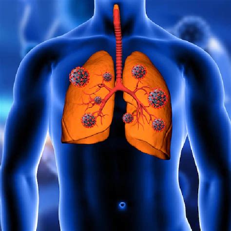 बैक्टीरियल निमोनिया क्या है? कारण, लक्षण और इलाज | Bacterial Pneumonia ...