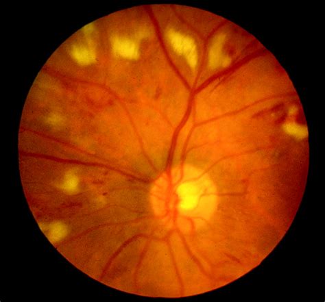 Retinal Cotton Wool Spot at Levi Rounsevell blog