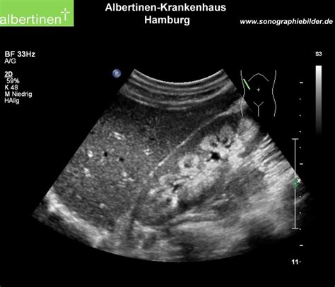 Medullary Sponge Kidney