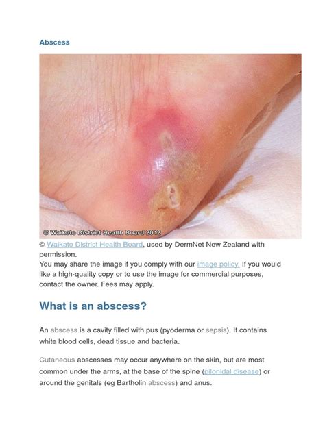 Infected Abscess Lanced 的图像结果