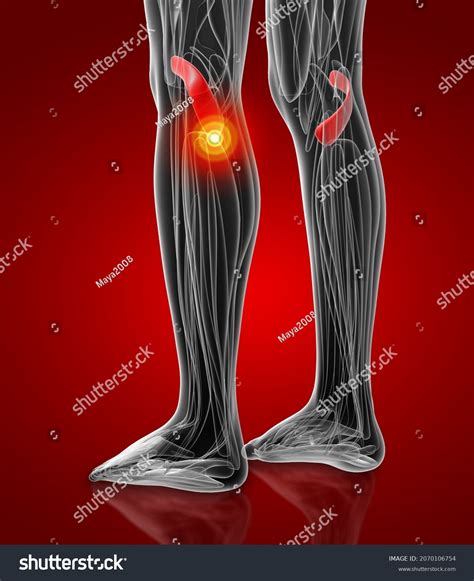 Popliteus Muscle Pain