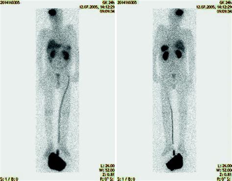 Image result for Radionuclide Scan