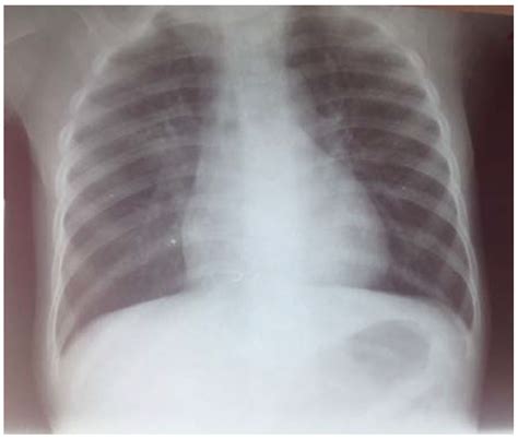 Pulmonary Localization of Mansonella perstans in a 16 Months-Old Male ...