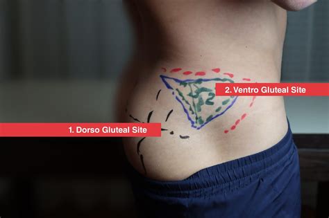 Ventrogluteal Self Injection Intramuscular Injections – Vendra