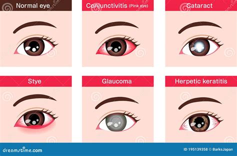 Diversas Enfermedades Oculares Ilustraciones Vectoriales De Ojo ...