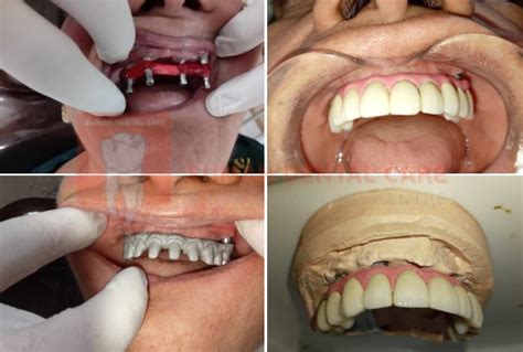 Full Mouth Rehabilitation with All-on-4 Implants Using Paulo Malo ...