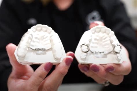 What are Palate Expanders and How Do They Work? — Cook Orthodontics of Dublin