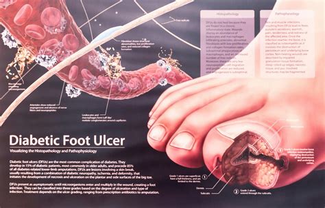 Plantar Wart Root Diagram